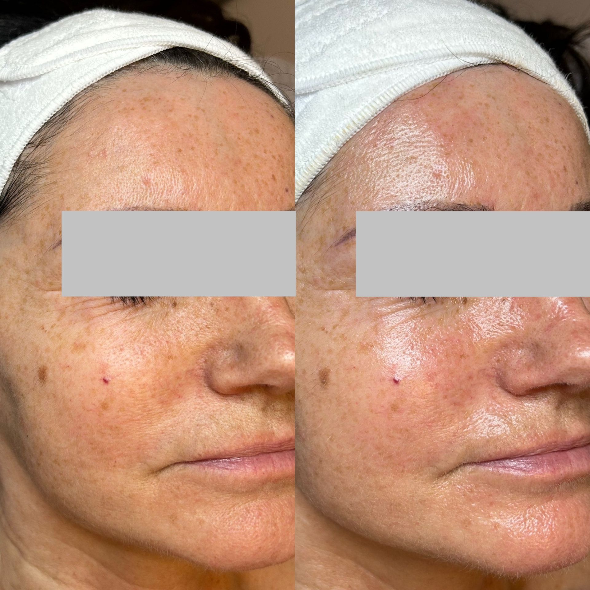 Stirn- und Wangenpartie im Halbprofil vor und nach einer HydraFacial Syndeo Behandlung, Augenbereich anonymisiert