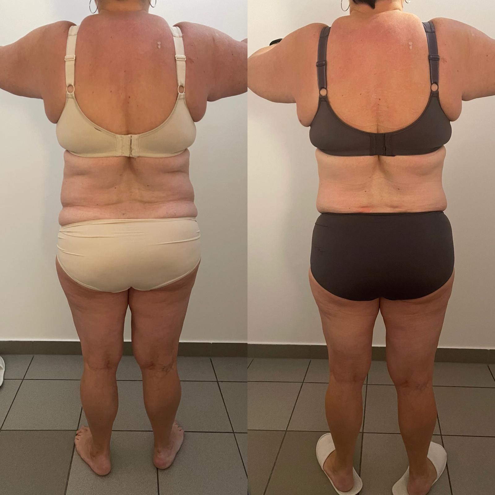 Rücken und Taille vor und nach LIPOSANA 3+ Anwendungen