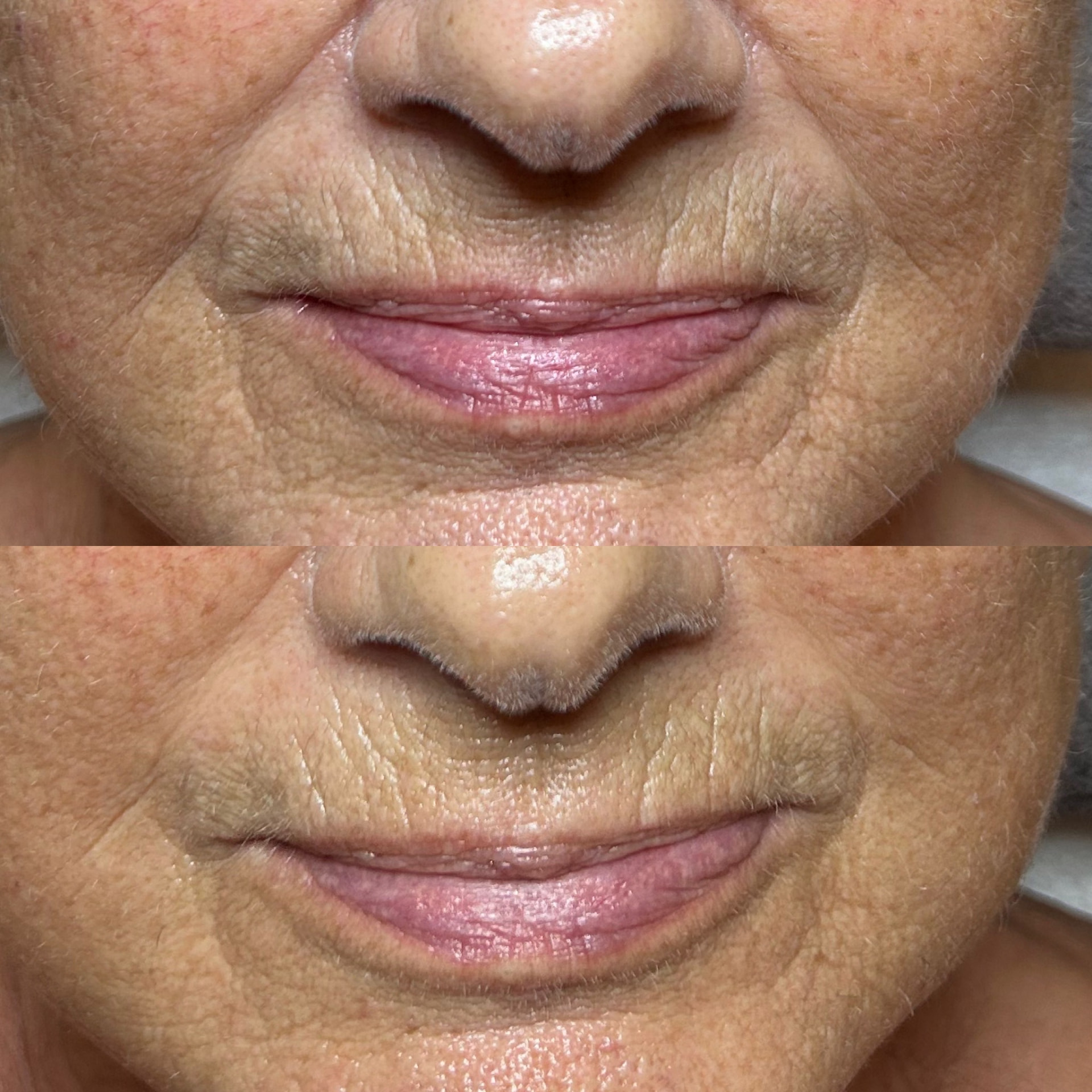 Mund- und Lippenpartie vor (oben) und nach (unten) einer INFUZION System Behandlung