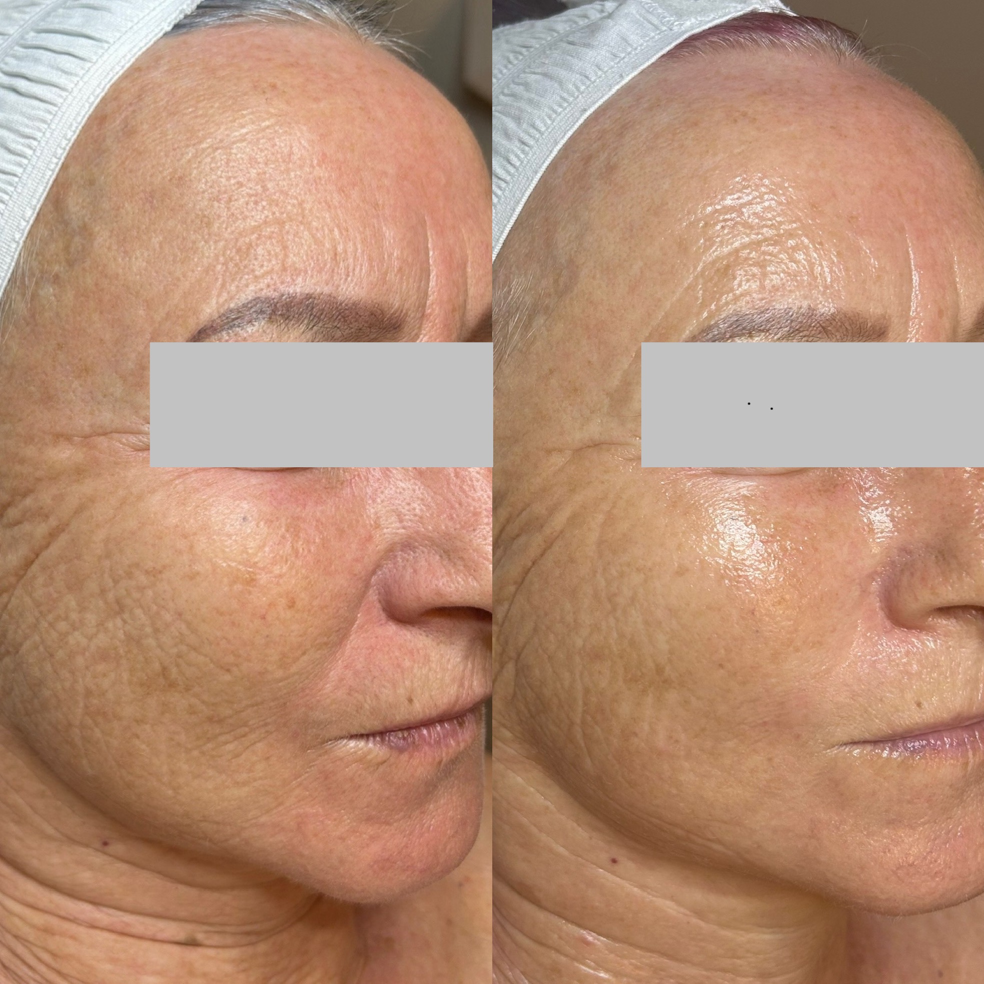 Gesicht im Halbprofil vor (links) und nach (rechts) einer JetPeel Behandlung, Augenpartie anonymisiert
