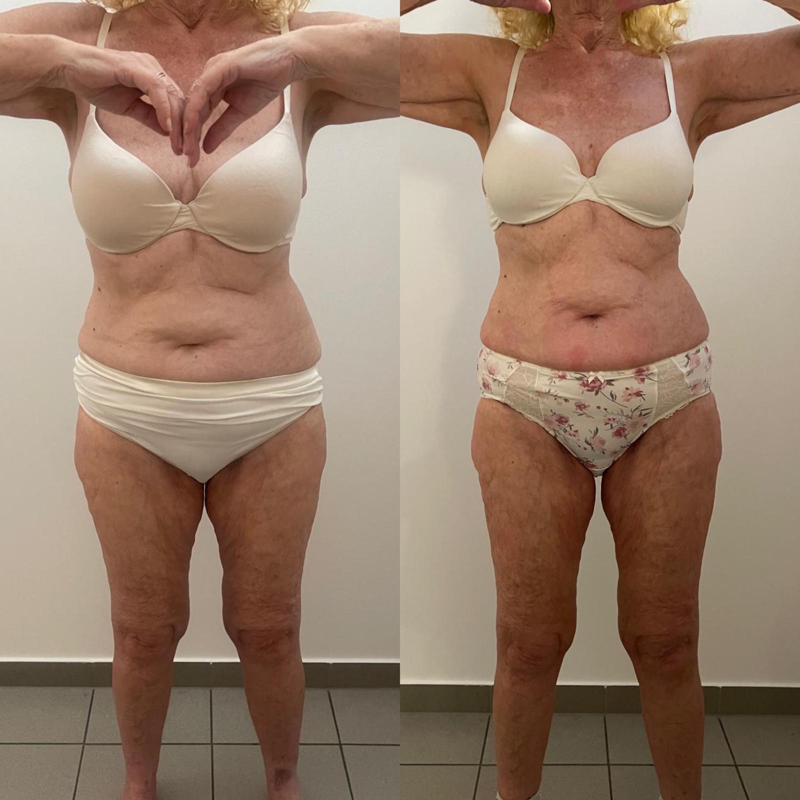 Körperkontur frontal vor und nach LIPOSANA 3+ Anwendungen