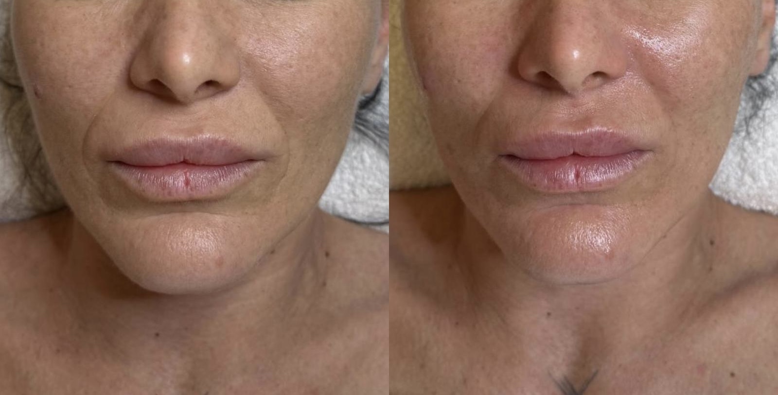 Mund-, Kinn- und Dekolletébereich vor und nach einer HydraFacial Syndeo Behandlung