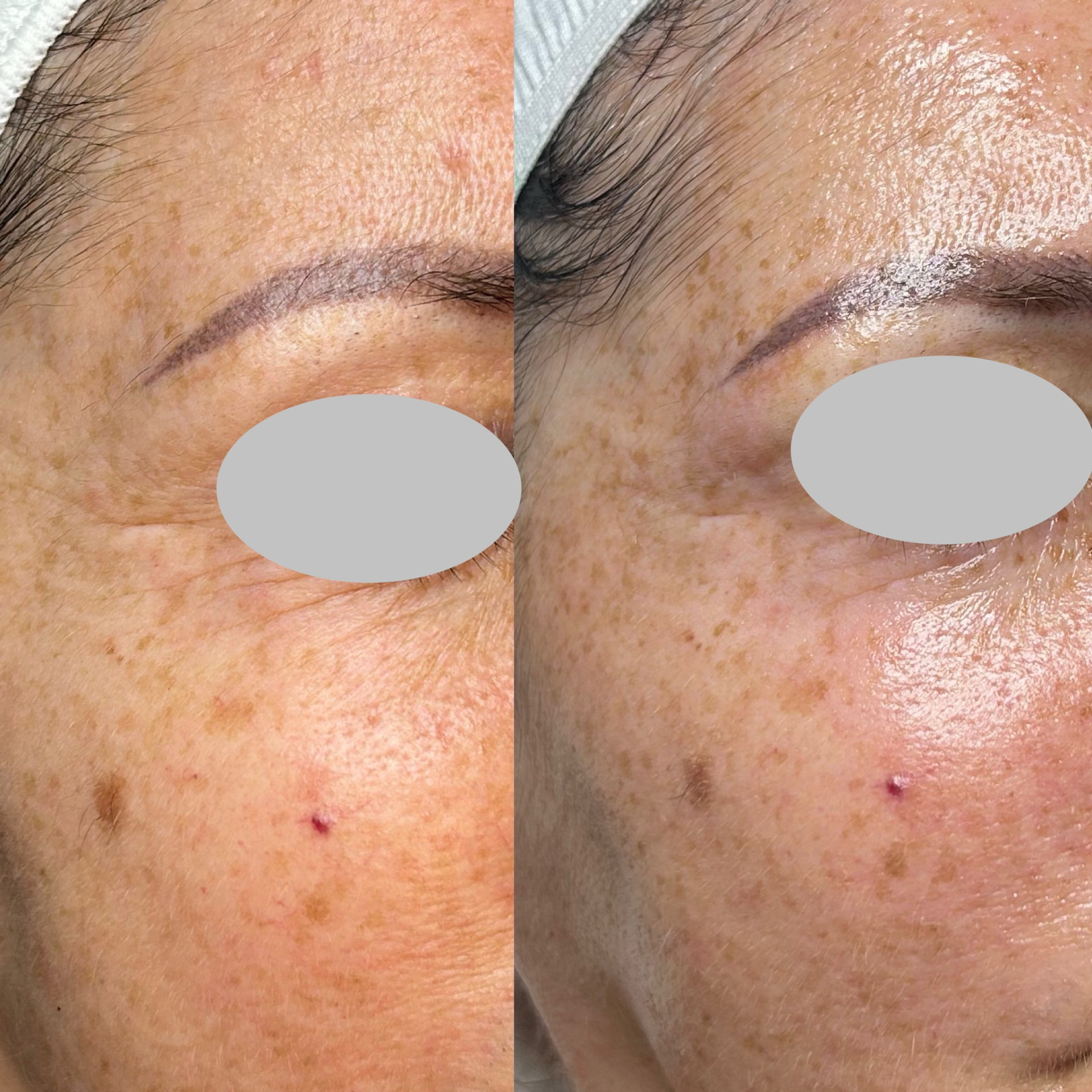Augen- und Wangenpartie im Halbprofil vor und nach einer HydraFacial Syndeo Behandlung, Augenbereich anonymisiert
