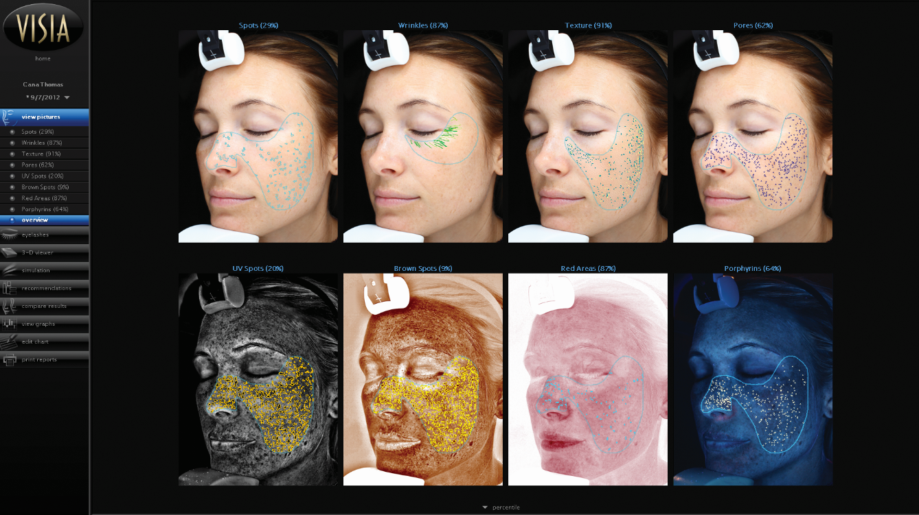 VISIA Auswertung mit Aufnahmen zu Pigment, Falten, Textur, Poren und UV-Anteilen
