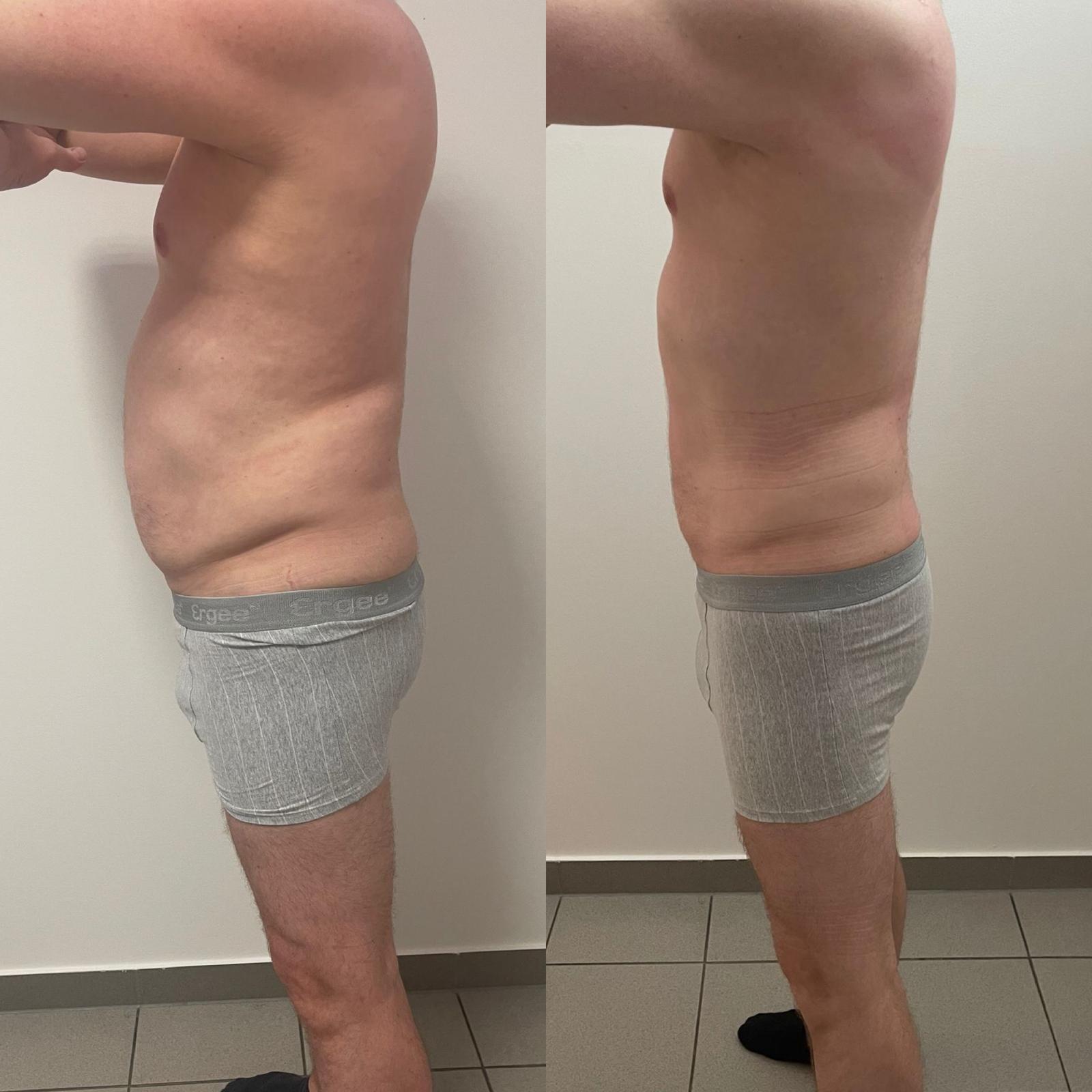 Bauchpartie seitlich vor und nach LIPOSANA 3+ Anwendungen